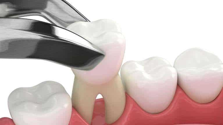 Dental extraction tool removing a tooth illustration.